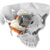 LaserImplant Zygomatic placement guide